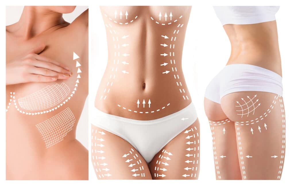 a BBL, or Brazilian Butt Lift, can be combined with other procedures in a treatment plan known as a mommy makeover. This is because a BBL is typically performed in conjunction with other body contouring procedures, such as liposuction, to enhance the overall shape and appearance of the body.