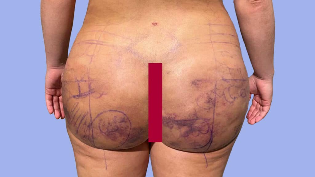 Complications of brazilian butt Lift