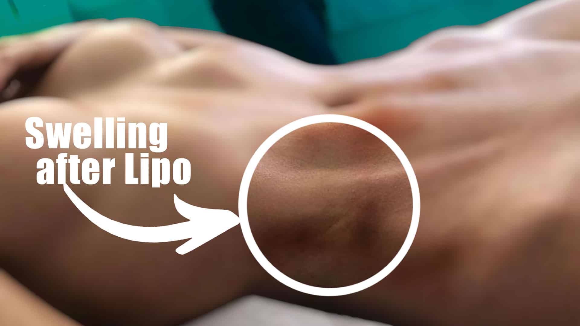 "Liposuction Swelling: What You Need to Know and How to Overcome It"