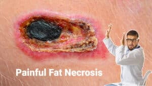 Painful-Fat-Necrosis-after-BBL