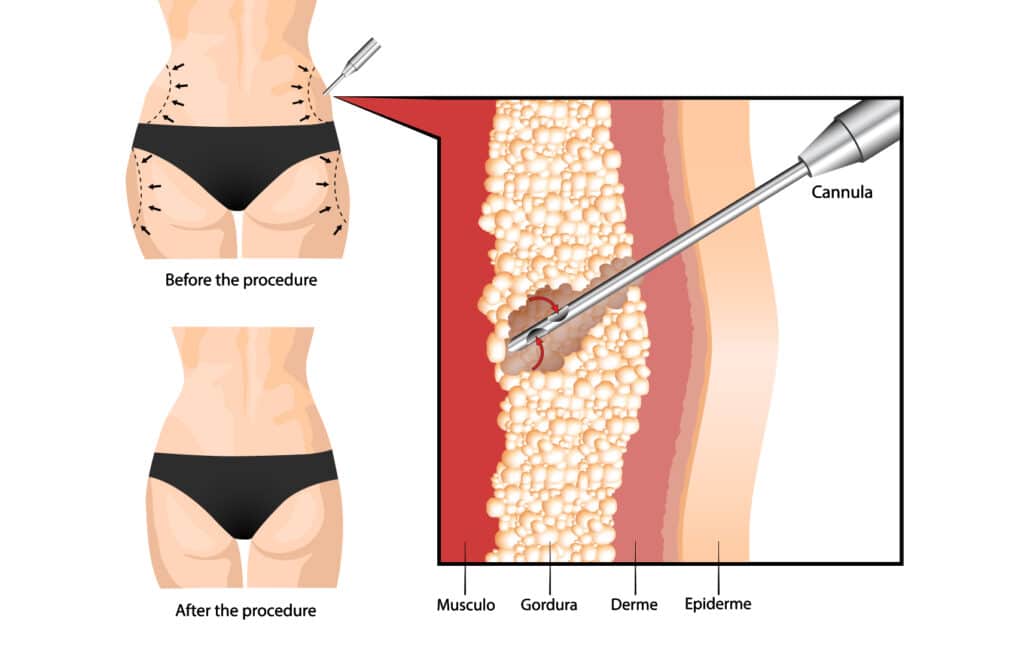 Reasons why a patient can't receive fat from another patient for a bbl procedure.
Compatibility: The fat used for a BBL procedure must be compatible with the recipient's body to be successful. This means that the fat must be healthy and free of any diseases or infections that could be transmitted to the recipient.

Safety: Receiving fat from another patient carries a number of potential risks and complications. For example, there is a risk of transmission of infections or diseases, such as HIV or hepatitis, from the donor to the recipient. In addition, there is also a risk of rejection of the fat by the recipient's body, which could lead to complications such as inflammation and scarring.

Effectiveness: There is also a question of effectiveness when using fat from another patient for a BBL procedure. It is generally impossible to predict how well the fat will take to the recipient's body or how long it will last after the procedure.