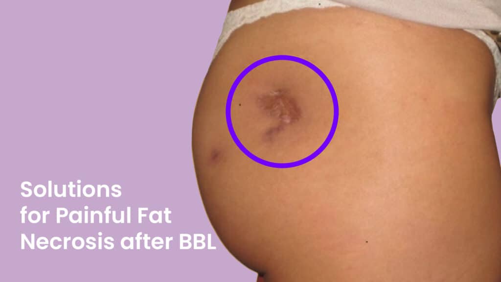 Solutions for Painful Fat Necrosis after BBL
If you are experiencing painful fat necrosis after a Brazilian butt lift (BBL) procedure, you must contact your plastic surgeon immediately. They will be able to examine the affected area and determine the appropriate treatment.