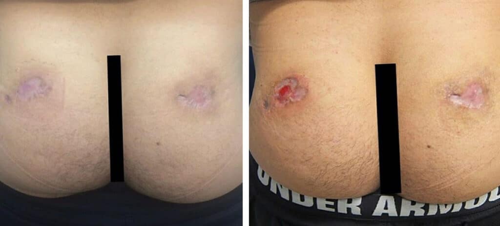 Symptoms of Necrosis
Fat necrosis after a Brazilian Butt Lift (BBL) procedure can be a concern for patients. Necrosis is when fat cells die and are replaced by scar tissue. It can be caused by trauma to the fat cells during the procedure, blood supply issues, infection, or inflammation.