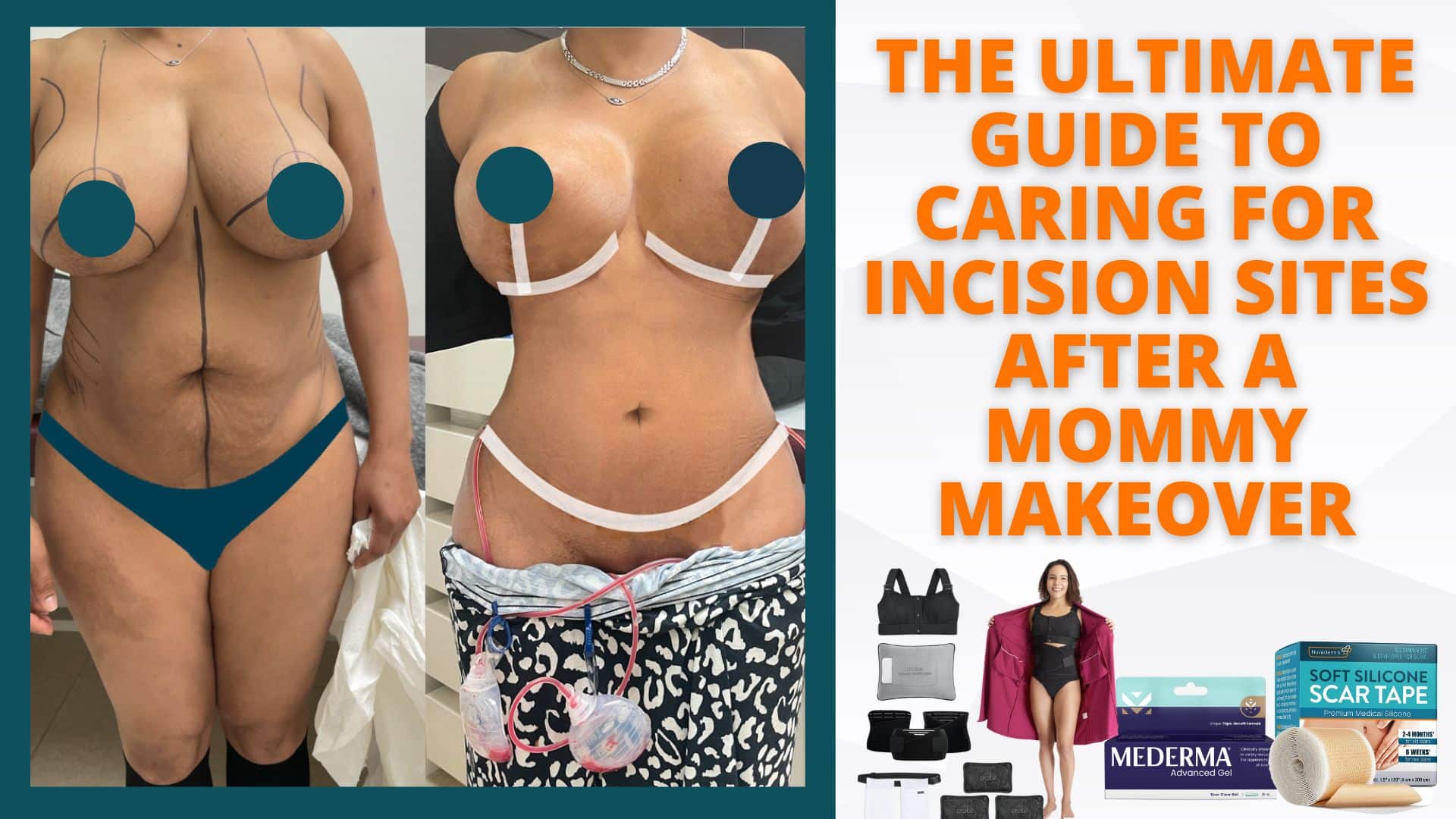 The Ultimate Guide to Caring for Incision Sites after a Mommy Makeover