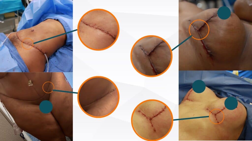 Understanding Your Incision Sites