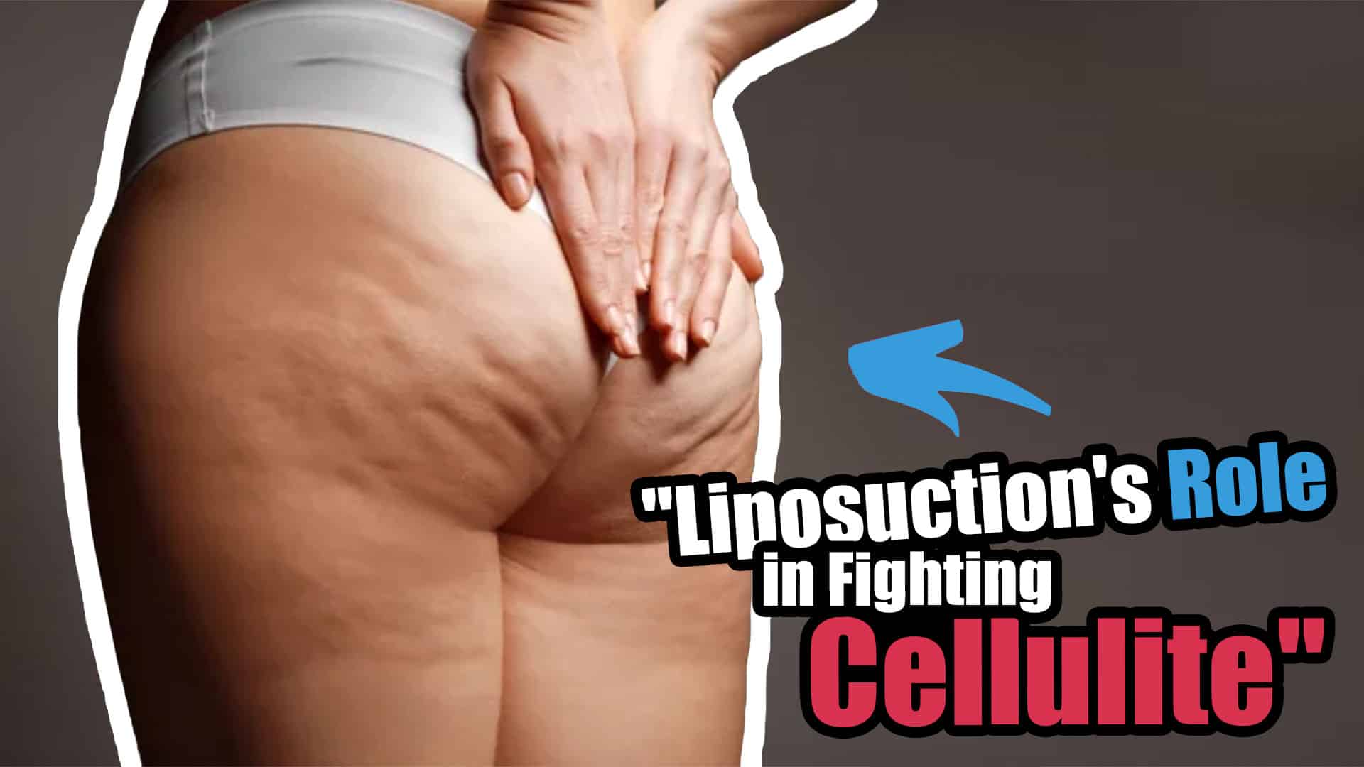 Unlock The Secret To Smooth Skin Liposuction’s Role In Fighting Cellulite