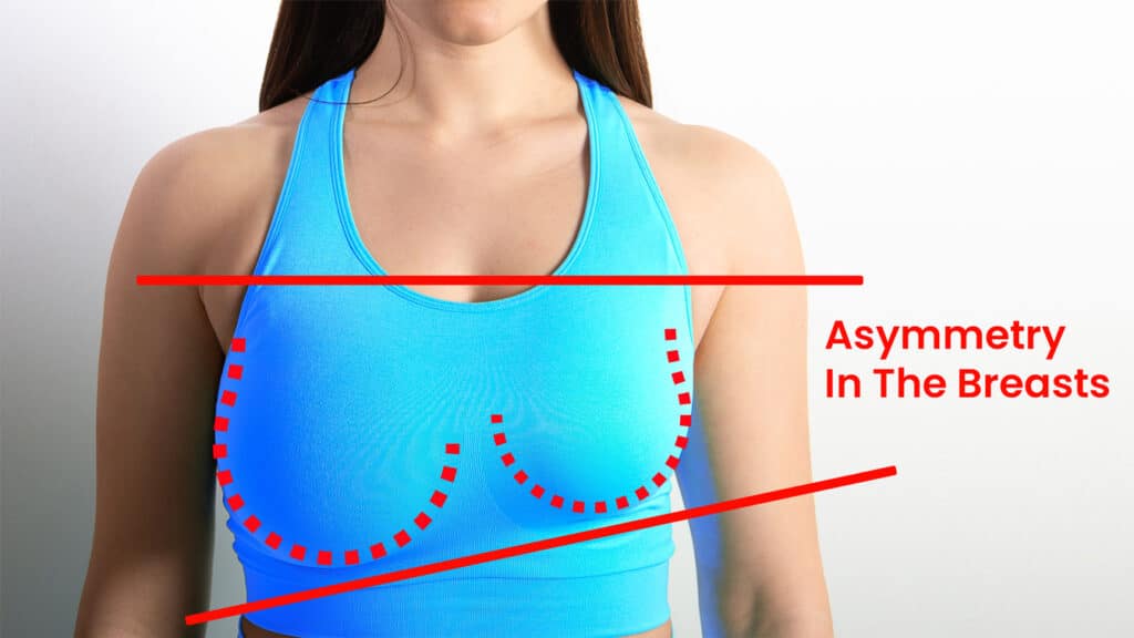 Can a mommy makeover address asymmetry in the breasts after pregnancy?
Yes, a mommy makeover can help address breast asymmetry after pregnancy. Asymmetry of the breasts can occur due to various factors, including pregnancy, breastfeeding, and weight fluctuations.