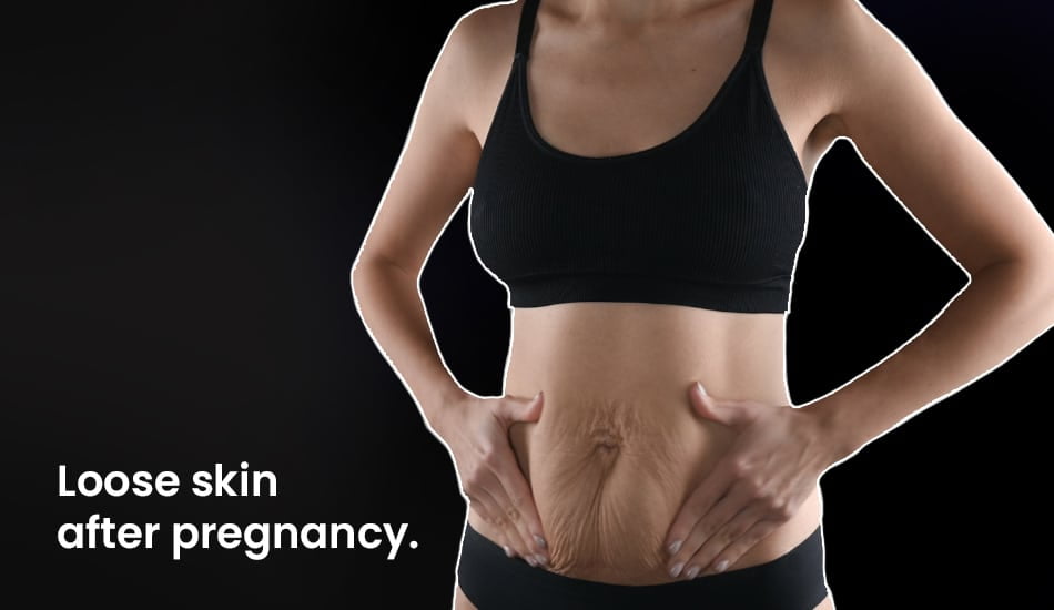 loose skin after pregnancy 