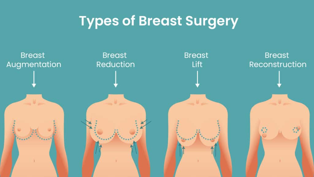 What types of breast surgery are included in a mommy makeover?
Breast Augmentation, Breast Lift, Breast Reduction, Breast Reconstruction.
