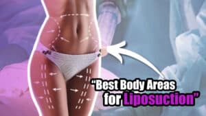 "The Best Body Areas for Liposuction: Unleash Your Inner Goddess"