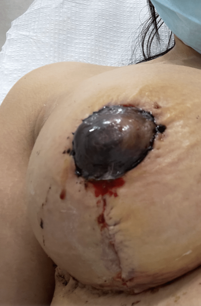 Pictured: Alejandra Mercedes nipples following the surgery
