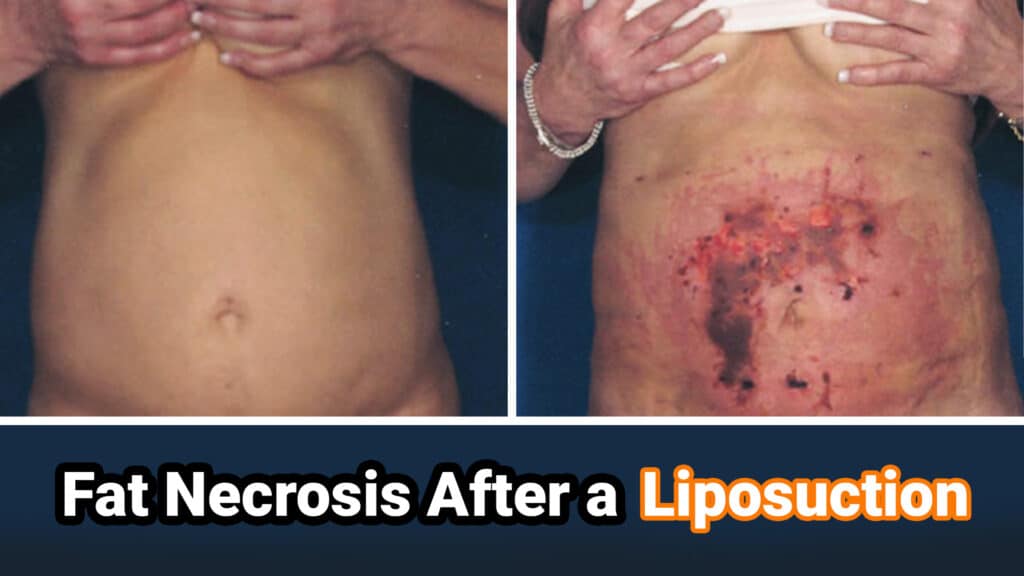 Fat-Necrosis-After-a-Liposuction