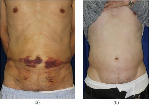 Fat necrosis after liposuction