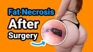 Fat-necrosis-after-surgery