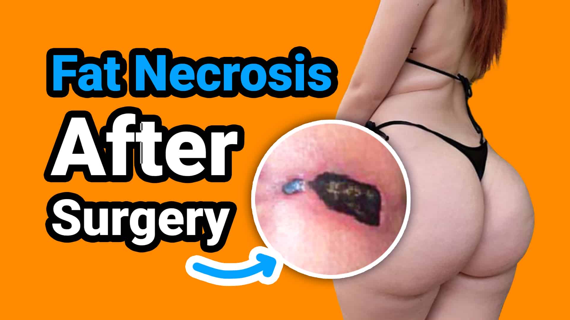 Fat-necrosis-after-surgery