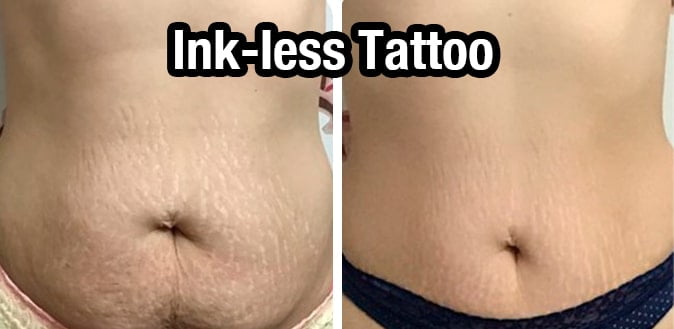 How-Inkless-Tattoos-Work-for-Stretch-Marks