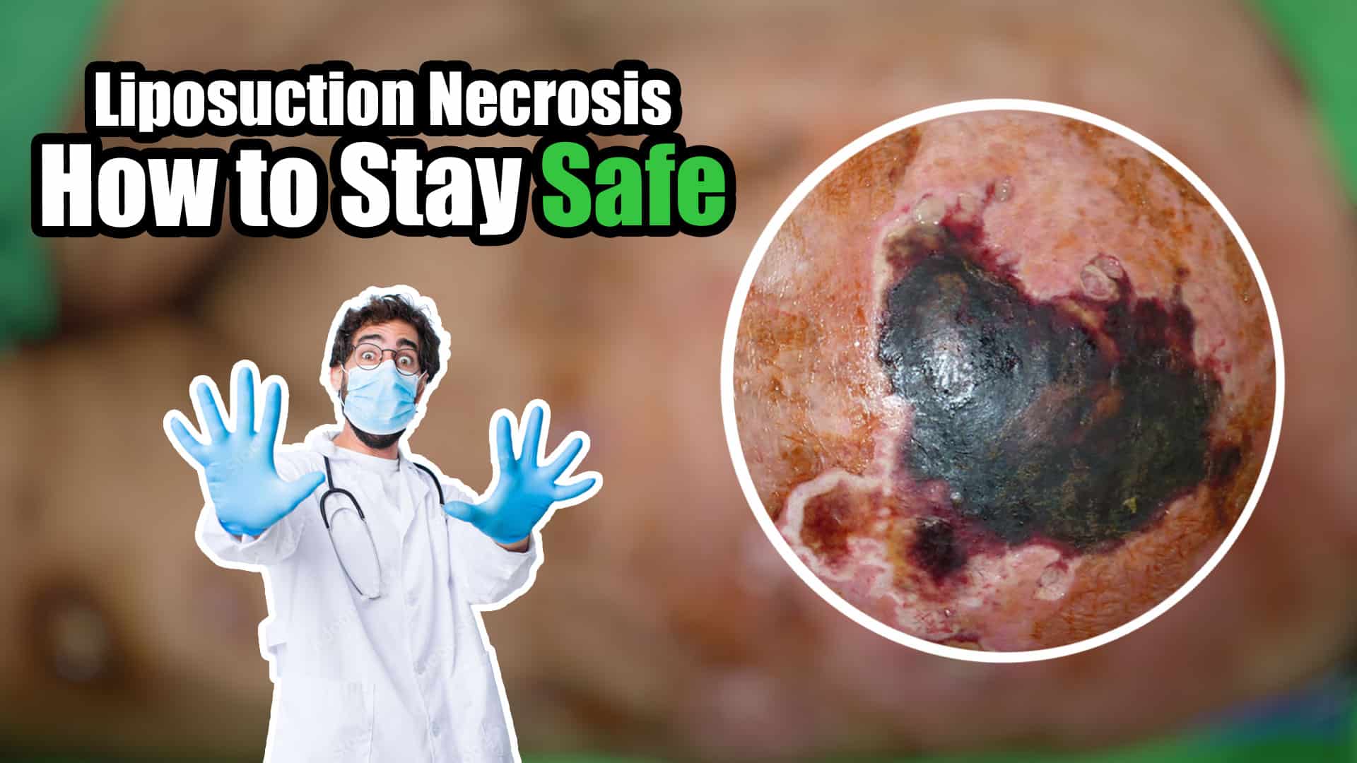 Liposuction Necrosis Understanding the Top 4 Causes and How to Stay Safe