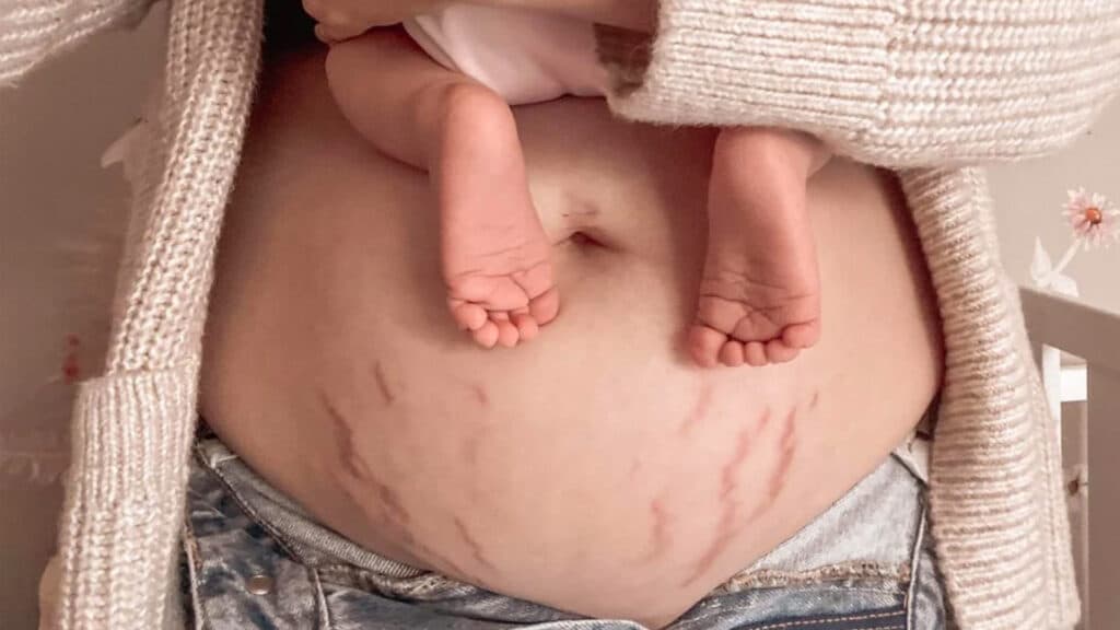 Pregnancy-stretch-mark-tattoo-cover-up.