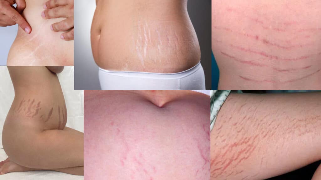 Typical-areas-of-the-body-where-stretch-marks-occur