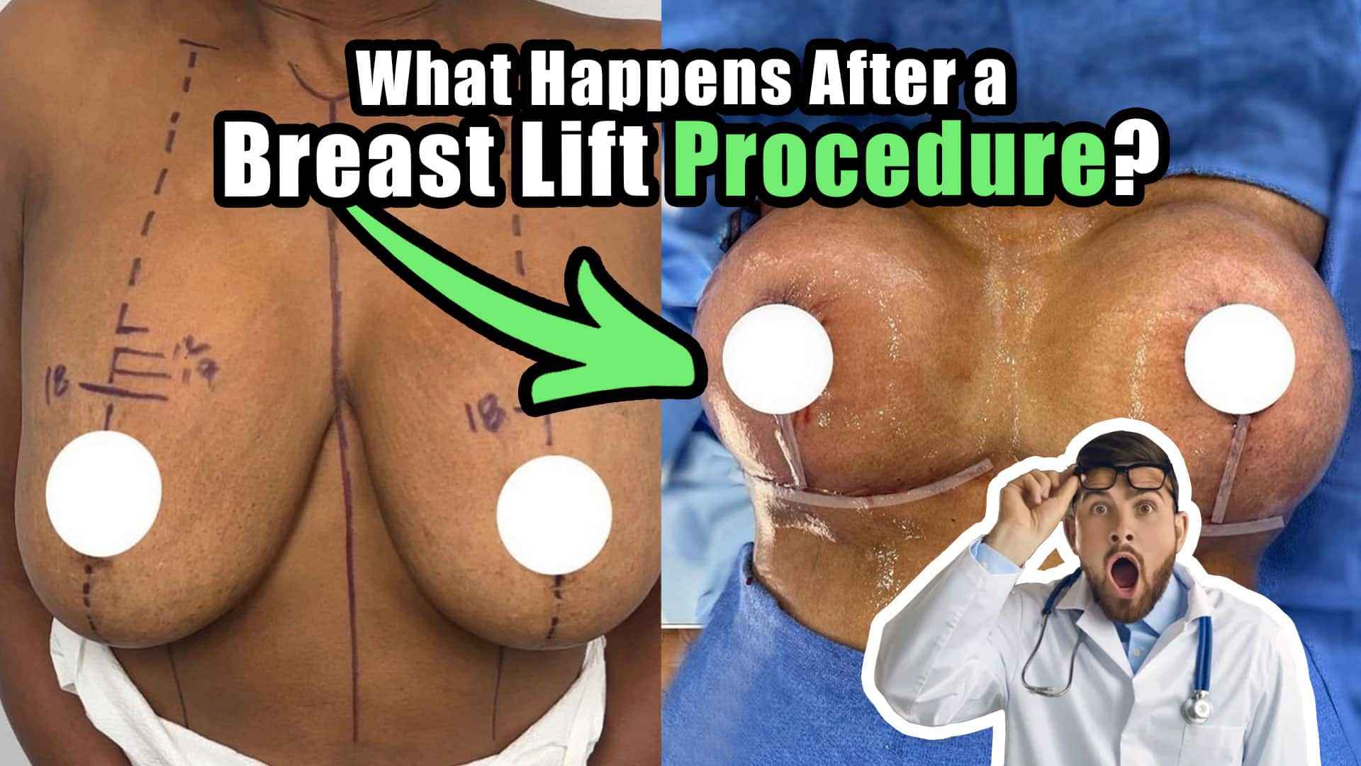 What Happens After a Breast Lift Procedure?