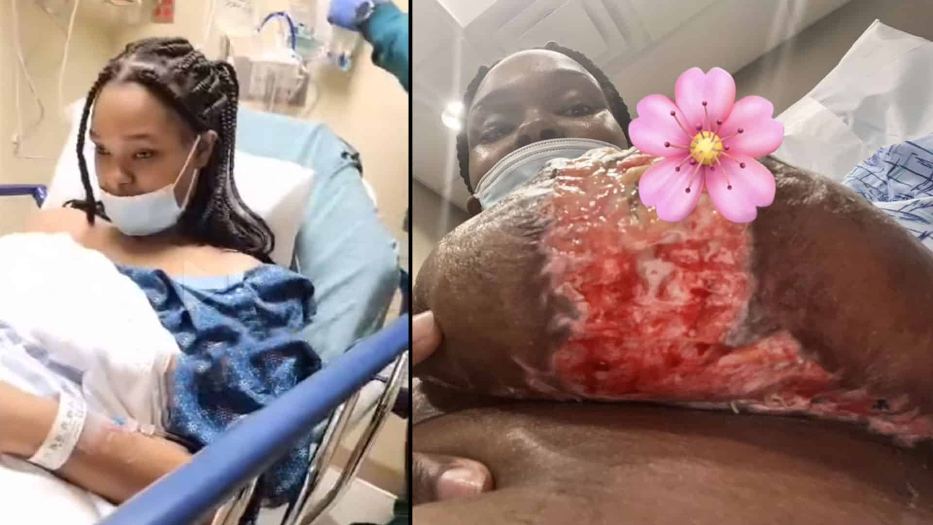 Woman had Breast Reduction Surgery, and her Boobs Fell Apart At Avana Plastic Surgery