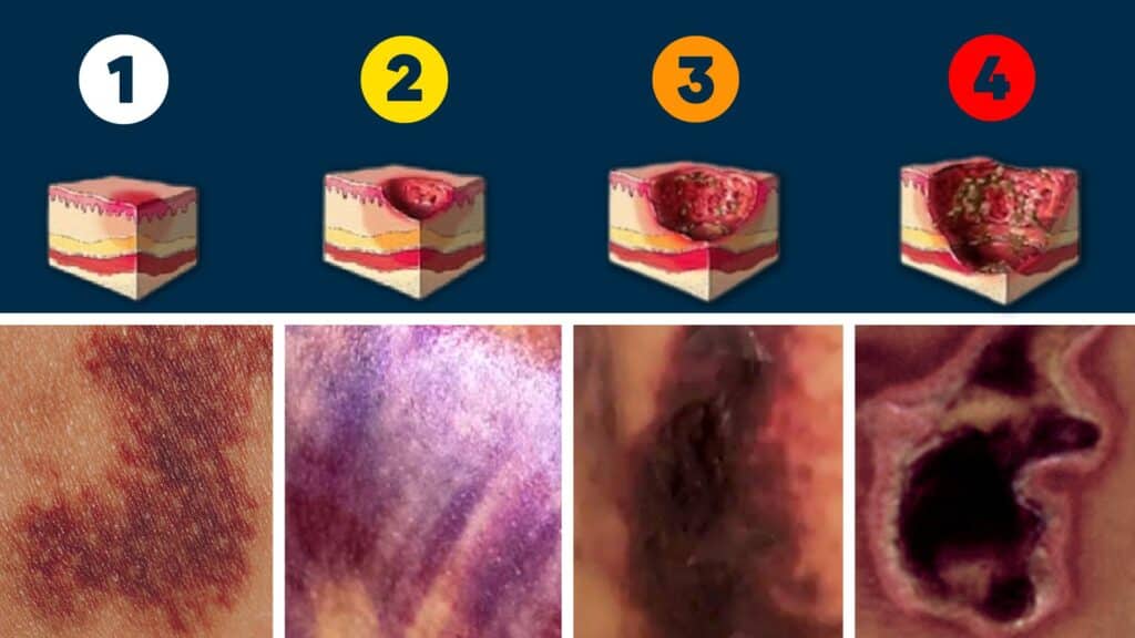 fat necrosis stages infographic