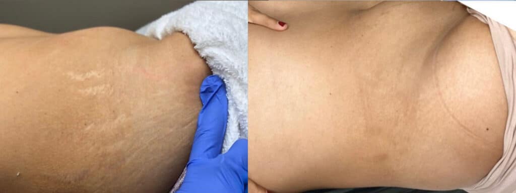 inkless-tattoo-for-stretch-marks