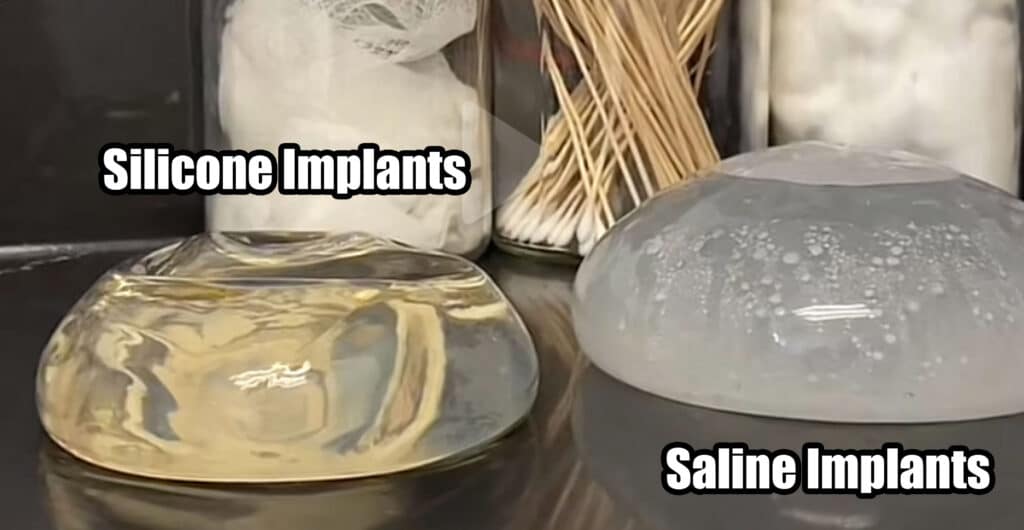 Are there different types of breast implants with varying lifespans?