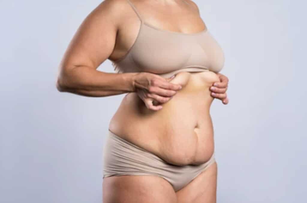 BMI-requirements-for-tummy-tuck