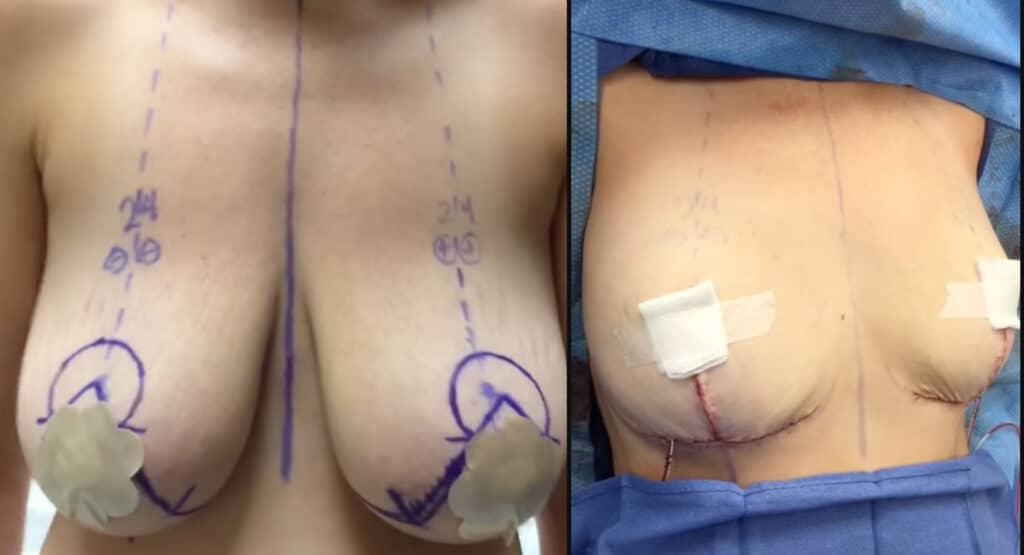 Breast Reduction: Before and Immediately After