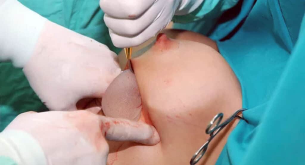 Breast augmentation surgery
