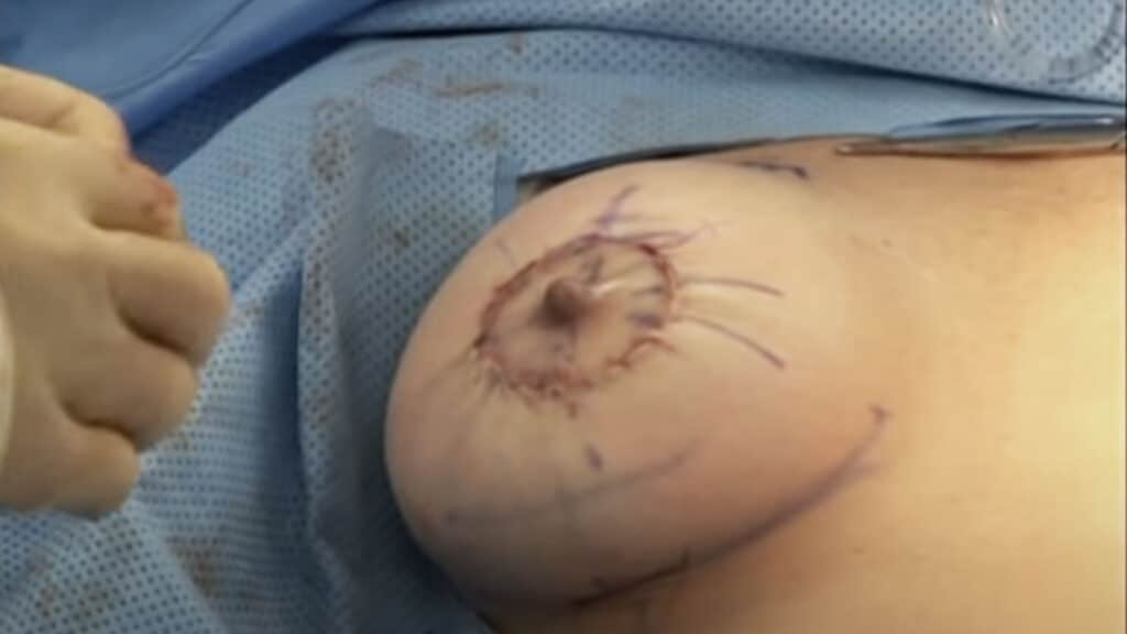 Can a breast lift be performed without leaving any visible scars?