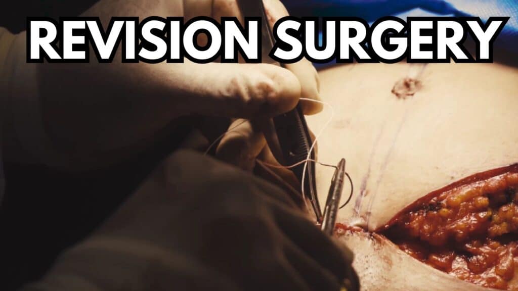 Can a revision surgery fix a failed tummy tuck?