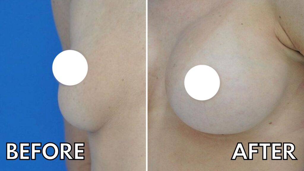 Candidacy for Transaxillary Breast Augmentation