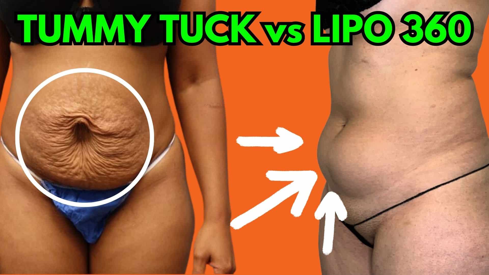 Difference between Lipo 360 vs Tummy Tuck: Which One's Right for You?