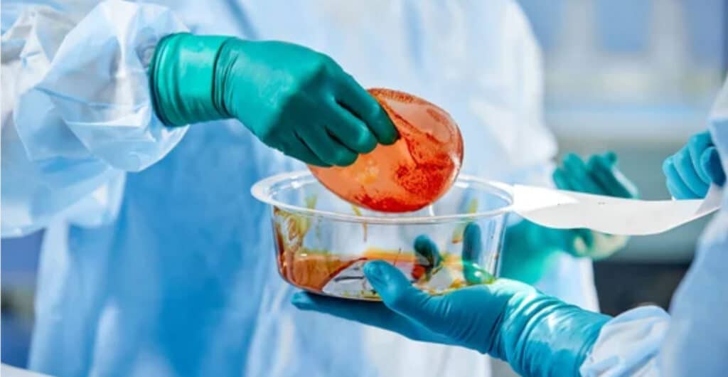 Doctor holding silicone implants for breast augmentation in operating room, closeup. Cosmetic surgery
