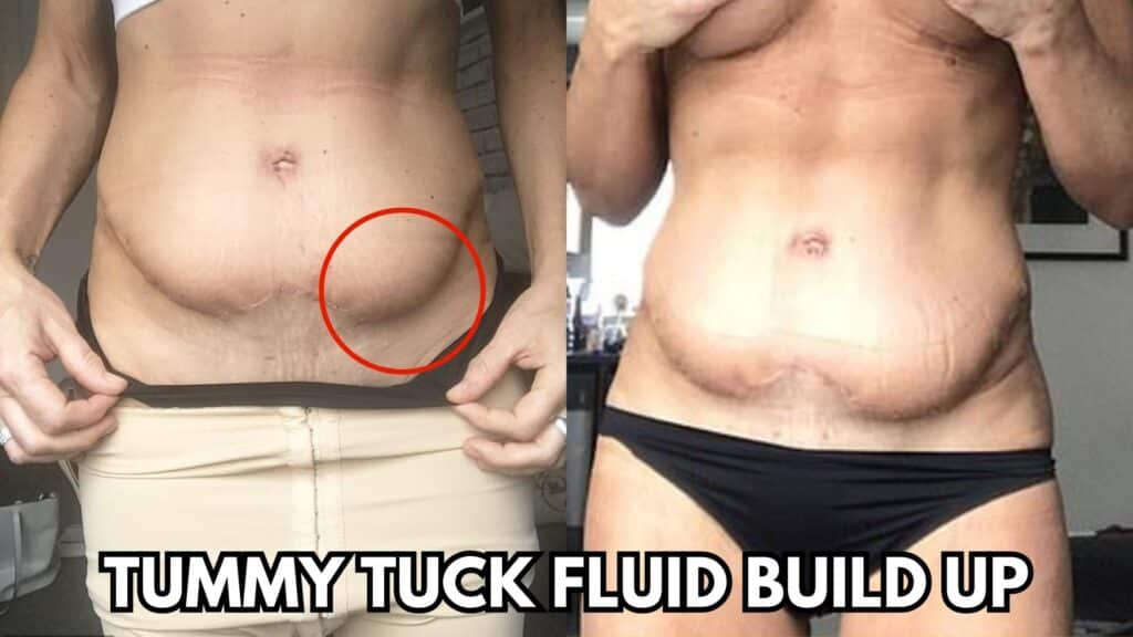 Drainless Tummy Tuck Pros