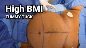 HIGH-BMI-Tummy-Tuck