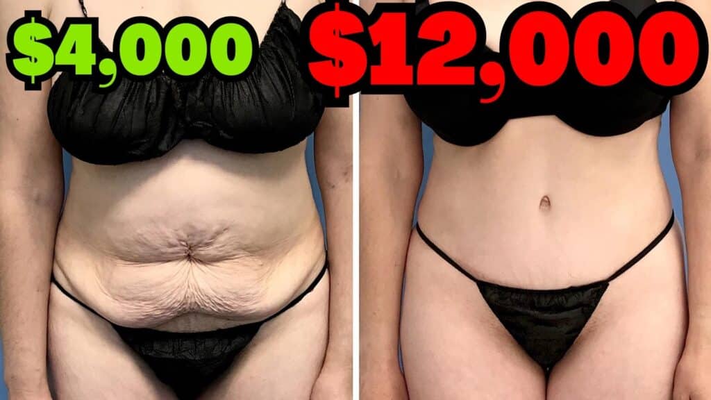 How much does a tummy tuck cost on average?