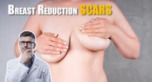 How to Minimize Breast Reduction Scarring and Rock Your New Look! - 5 Tips You Need to Know!