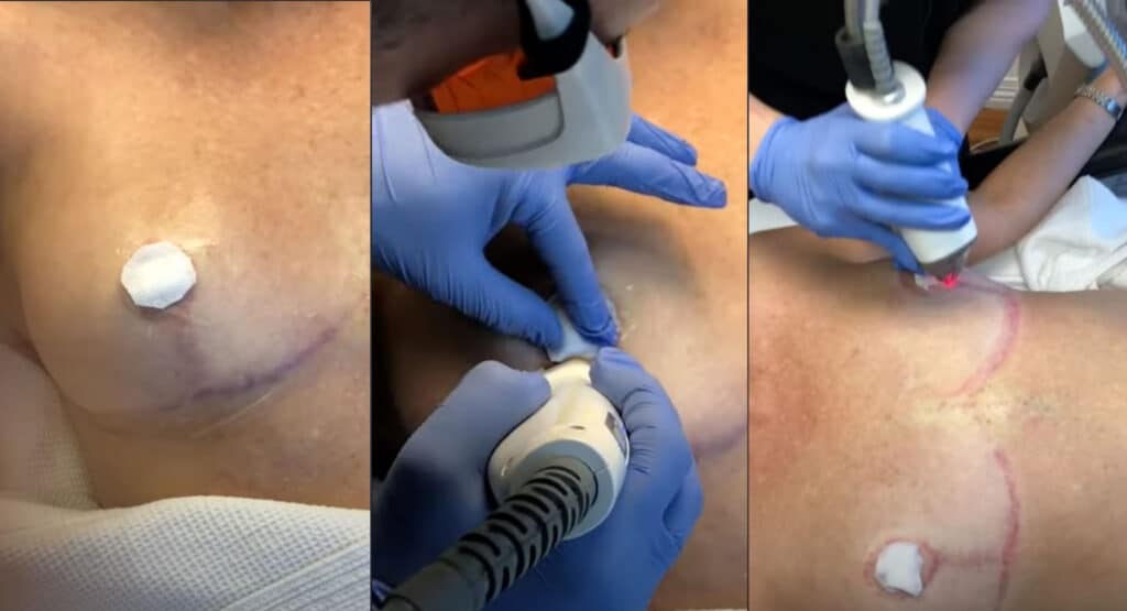 IMPROVE SURGICAL BREAST SCARS, BODY KELOIDS WITH FRAXEL + EXCEL V VASCULAR LASER