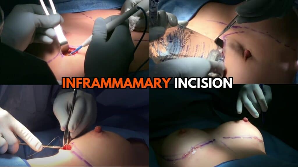 Inframammary Incision Placement (1)