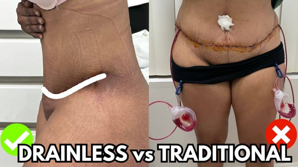 Is the drainless tummy tuck procedure better than the traditional tummy tuck