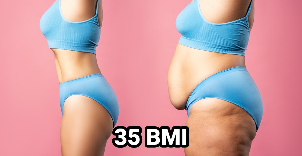 My-BMI-is-35-can-I-get-a-tummy-tuck-