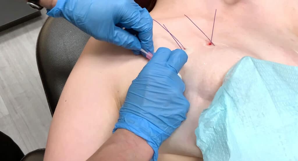 Non-Surgical Breast Lift with PRP & PDO Threads
