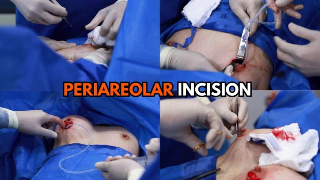 Periareolar Incision Placement Options