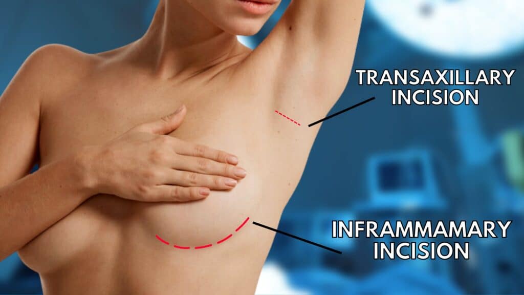 Pros of Transaxillary Breast Augmentation