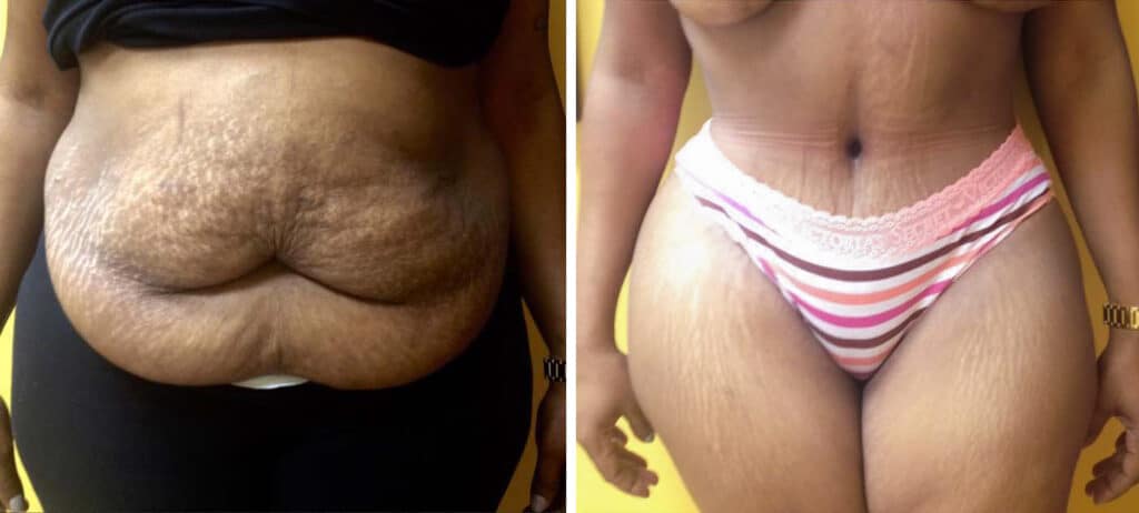 Recovery-after-a-high-BMI-Tummy-Tuck-surgery