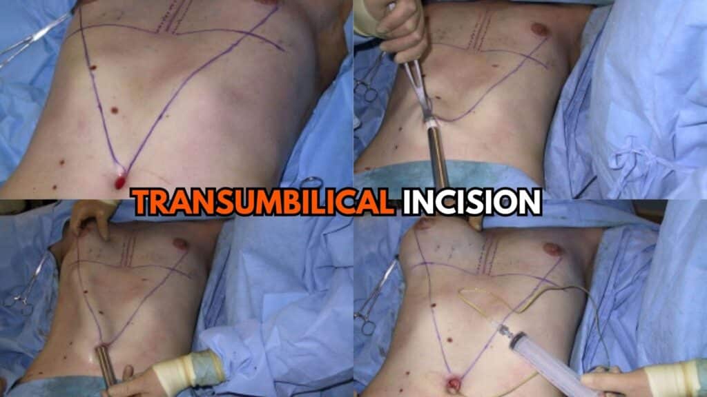 Transumbilical Incision Placement