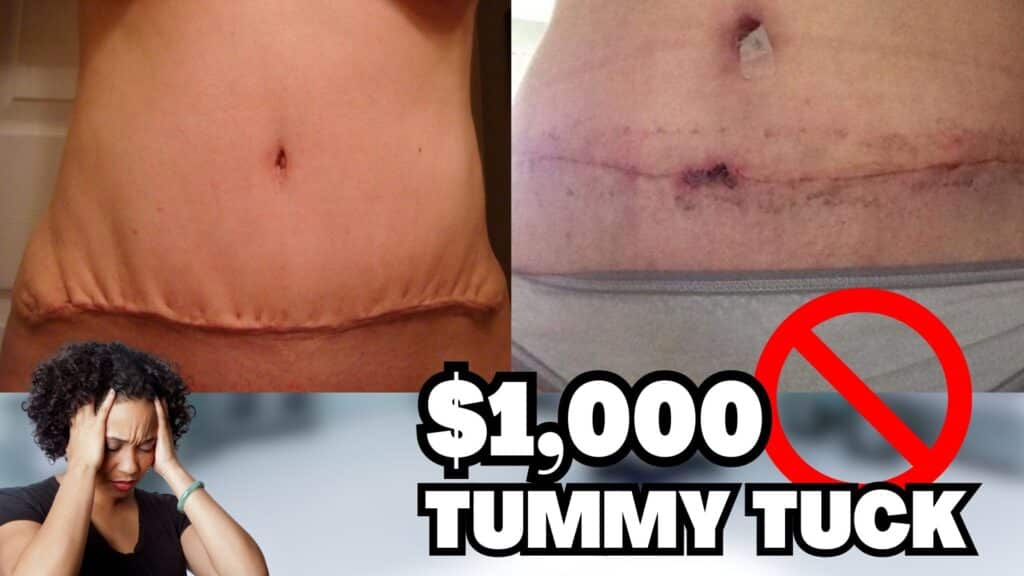 Truth #3: Don't be fooled by cheap tummy tuck offers